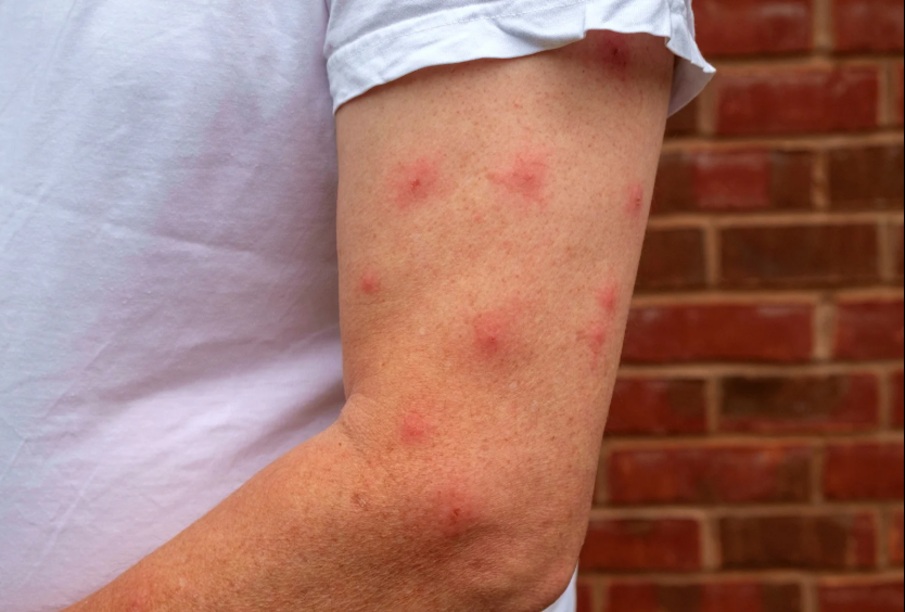 control de plagas en Valencia